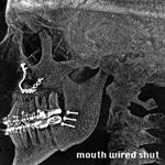 Mouth Wired Shut - Mouth Wired Shut