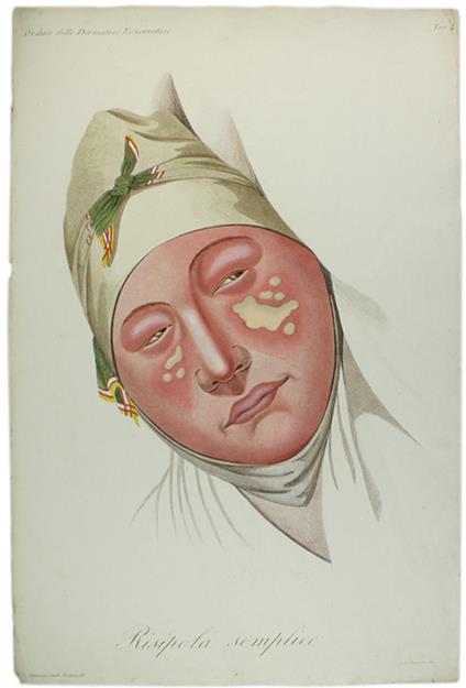 Tavola originale: RISIPOLA SEMPLICE. , N. 4  (da: CLINICA DEL PARIGINO SPEDALE DI S.LUIGI OSSIA TRATTATO COMPIUTO DELLA PELLE ...) - copertina