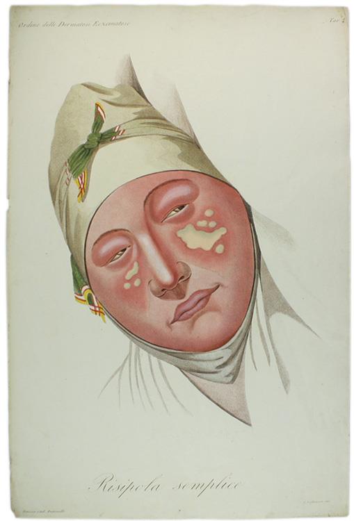 Tavola originale: RISIPOLA SEMPLICE. , N. 4  (da: CLINICA DEL PARIGINO SPEDALE DI S.LUIGI OSSIA TRATTATO COMPIUTO DELLA PELLE ...) - copertina