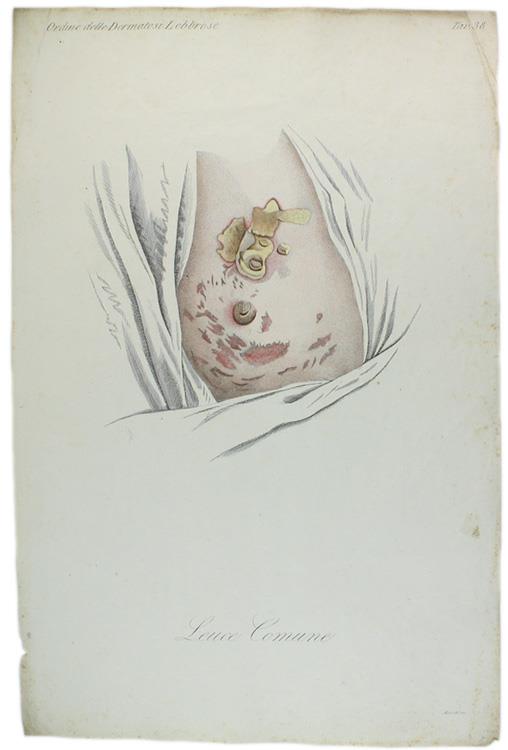 Tavola originale: LEUCE COMUNE., N. 38 (da: CLINICA DEL PARIGINO SPEDALE DI S.LUIGI OSSIA TRATTATO COMPIUTO DELLA PELLE ...) - copertina