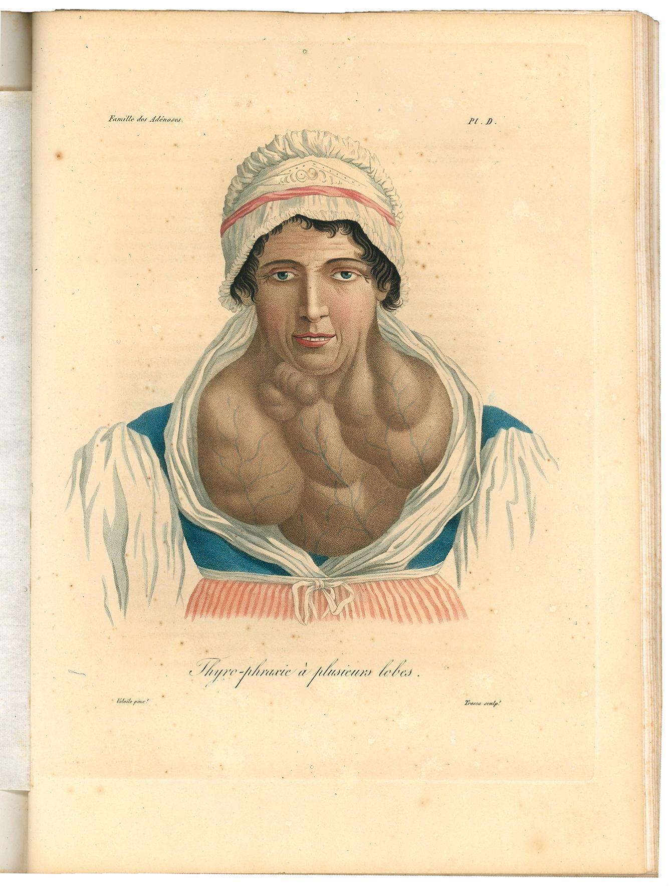 Nosologie naturelle ou les maladies du corps humain distribuées par familles [...] avec 33 planches coloriees. 1817