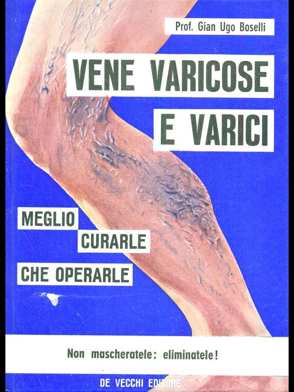 Vene varicose e varici