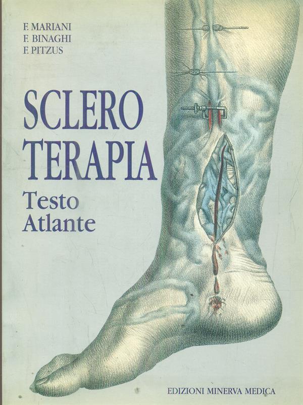 Scleroterapia