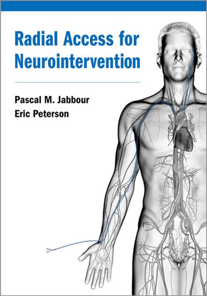 Radial Access for Neurointervention