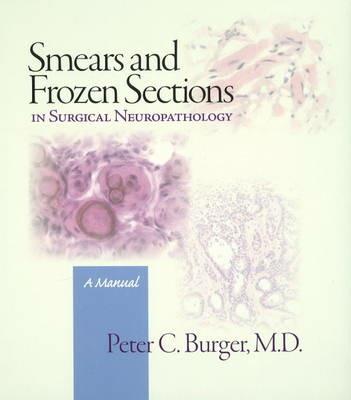 Smears and frozen sections in surgical neuropathology. A manual - Peter C. Burger - copertina