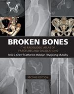 Broken Bones