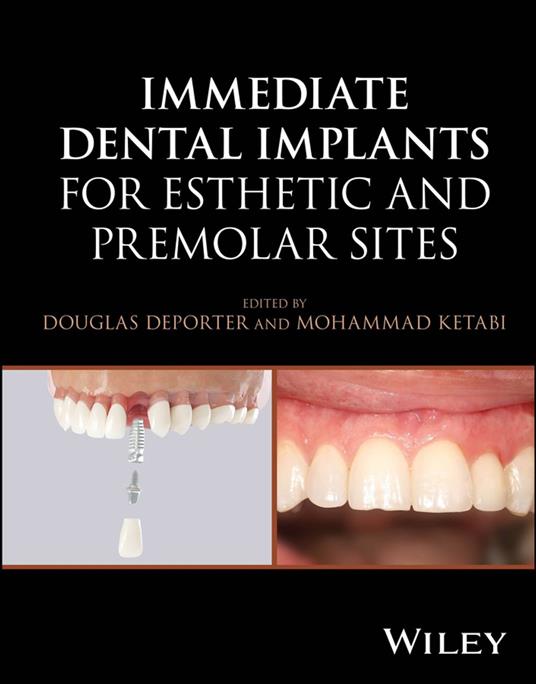 Immediate Dental Implants for Esthetic and Premolar Sites