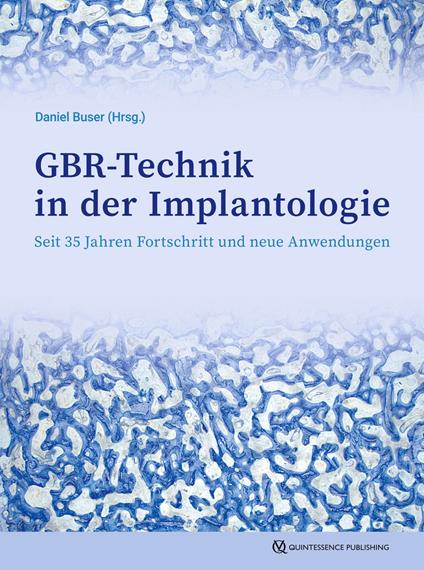 GBR-Technik in der Implantologie