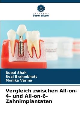 Vergleich zwischen All-on-4- und All-on-6-Zahnimplantaten - Rupal Shah,Real Brahmbhatt,Monika Varma - cover