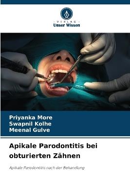 Apikale Parodontitis bei obturierten Zähnen - Priyanka More,Swapnil Kolhe,Meenal Gulve - cover