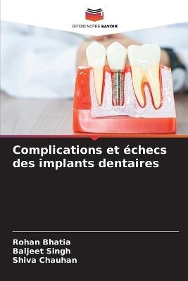 Complications et échecs des implants dentaires - Rohan Bhatia,Baljeet Singh,Shiva Chauhan - cover