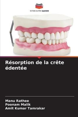 Résorption de la crête édentée - Manu Rathee,Poonam Malik,Amit Kumar Tamrakar - cover