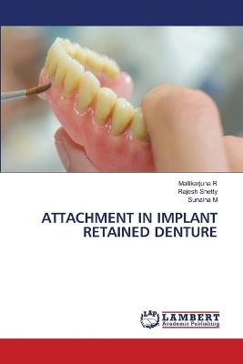 Attachment in Implant Retained Denture - Mallikarjuna R,Rajesh Shetty,Sunaina M - cover