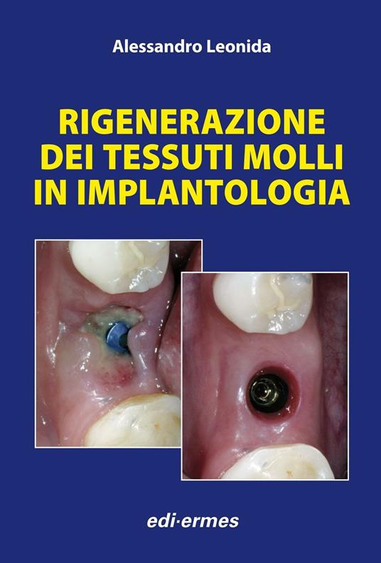 Rigenerazione dei tessuti molli in implantologia - Alessandro Leonida - copertina