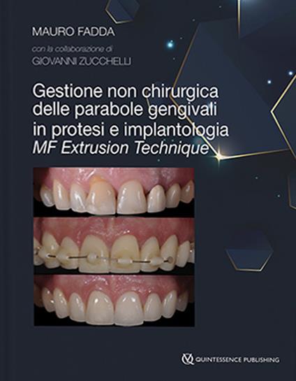Gestione non chirurgica delle parabole gengivali in protesi e implantologia. MF extrusion technique - Mauro Fadda,Giovanni Zucchelli - copertina