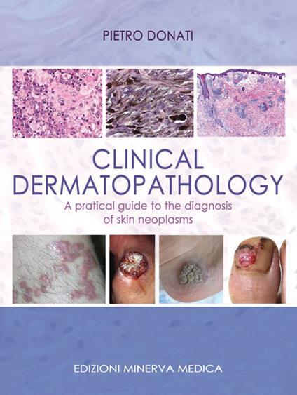 Clinical dermatopathology. A pratical guide to the diagnosis of skin neoplasms - Pietro Donati - copertina