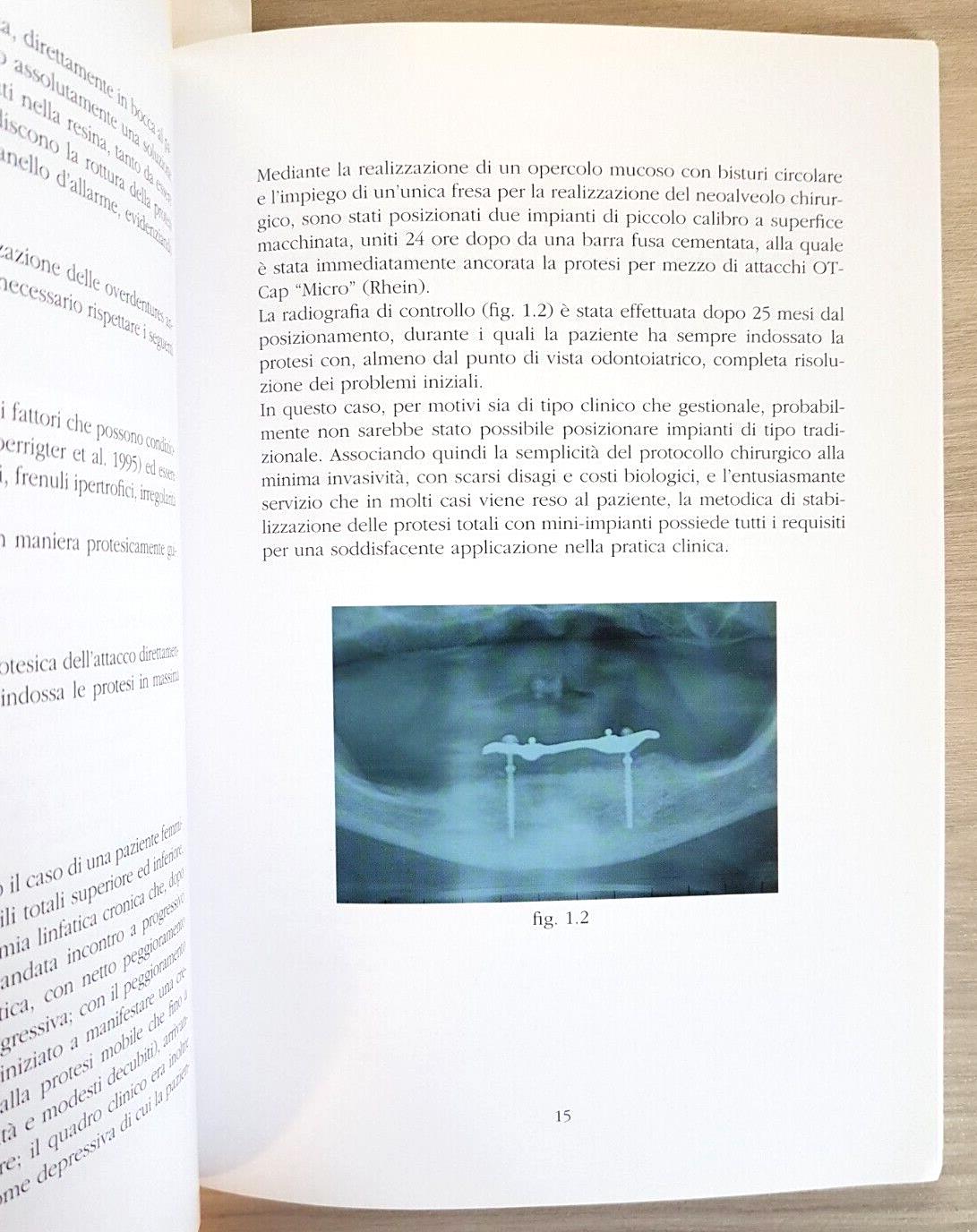 La stabilizzazione delle protesi mobili con impianti di piccolo calibro. Con DVD