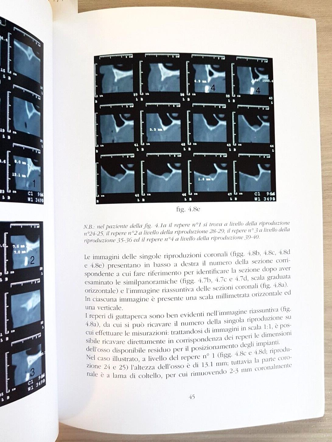 La stabilizzazione delle protesi mobili con impianti di piccolo calibro. Con DVD