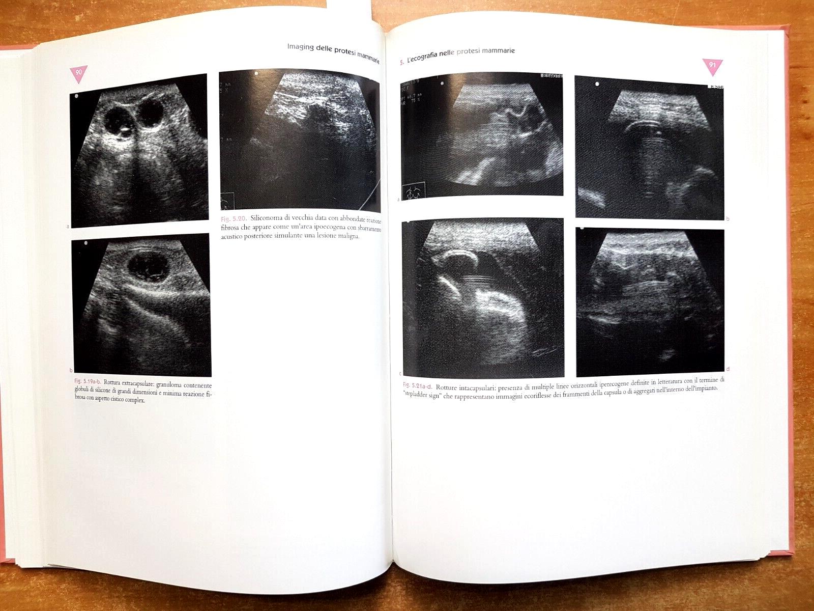 Imaging delle protesi mammarie