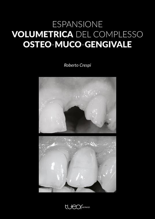 Espansione volumetrica del complesso osteo-muco-gengivale - Roberto Crespi - copertina