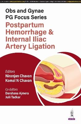 Obs and Gynae PG Focus Series: Postpartum Hemorrhage and Internal Iliac Artery Ligation - Niranjan Chavan,Komal N Chavan,Darshana Ajmera - cover