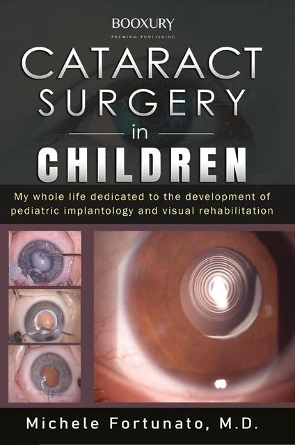 Cataract surgery in children - Michele Fortunato - copertina
