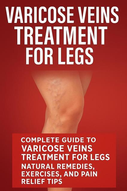 Varicose Veins Treatment for Legs: Natural Varicose Veins Treatment Remedies, Exercises and Pain Relief Tips